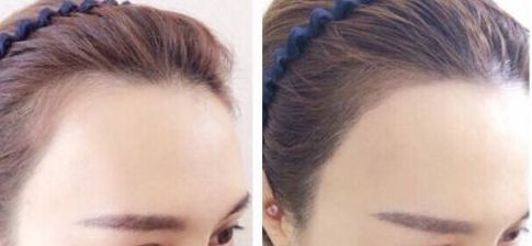 杭州疤痕整形哪家醫(yī)院好？選擇哪個(gè)醫(yī)院更靠譜？