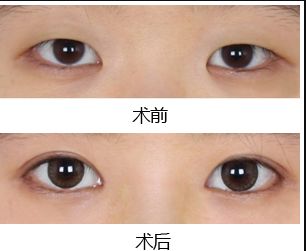 鄭州去黑點哪家醫(yī)院好？揭秘最受歡迎的黑點去除醫(yī)院