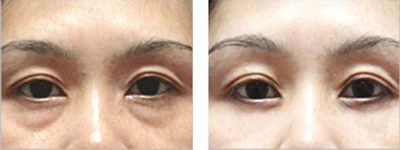 西安治療紅血絲哪家醫(yī)院查找費(fèi)用明細(xì)最全？