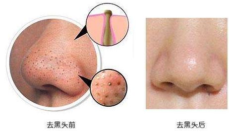 杭州哪家美容醫(yī)院吸脂效果最佳？