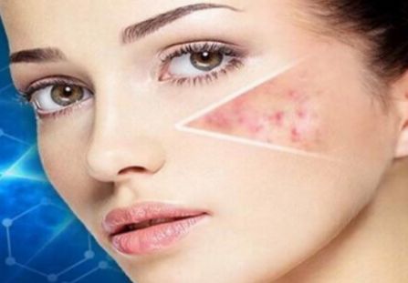 宜賓青春痘治療哪家醫(yī)院效果好？