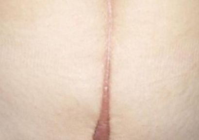 瀘州哪家醫(yī)院祛痘祛痘印好？全面解析瀘州專業(yè)祛痘醫(yī)院