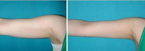 青島華諾整形：陳世俊的微整形經(jīng)驗(yàn)分享