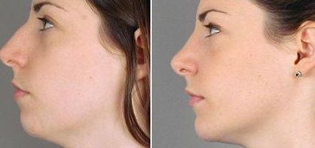 【2023邯鄲祛痘印醫(yī)院哪家好？專家推薦排行榜】