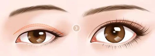 武漢美立方的胡江偉如何進(jìn)行雙眼皮手術(shù)？