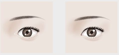 【吉林雙眼皮割的好，哪家醫(yī)院口碑最佳？】