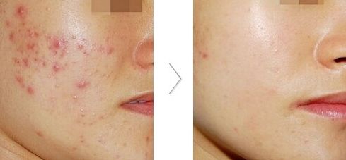 大連雙眼皮整形醫(yī)院哪家好？推薦大連哪家整形雙眼皮效果最佳