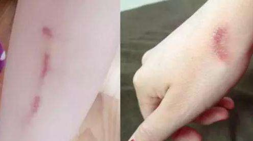 邵陽去痘去斑哪家醫(yī)院好？選擇正規(guī)醫(yī)療機(jī)構(gòu)，解決邵陽去痘去斑問題