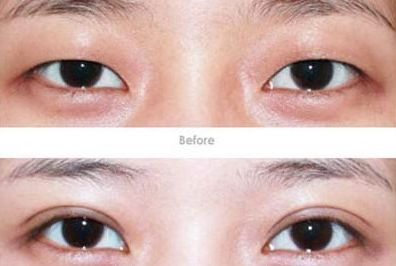 杭州開眼角醫(yī)生哪家好？專家推薦的杭州開眼角醫(yī)院排行榜