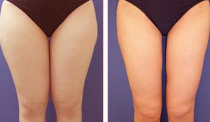 杭州去除雀斑哪家醫(yī)院好？天堂醫(yī)美專業(yè)美容師傾情解答！