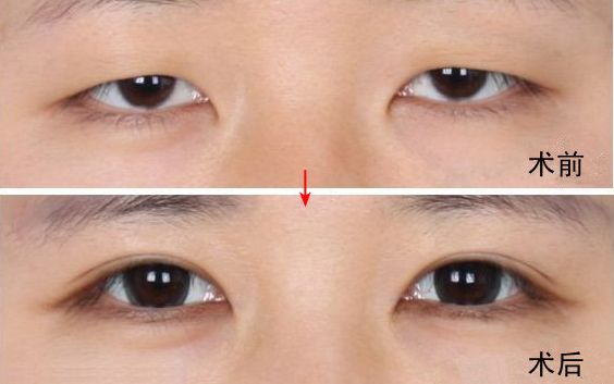 南京哪家醫(yī)院去眼袋好？眼袋手術(shù)選哪家醫(yī)院最好