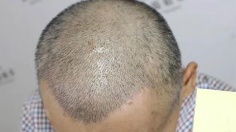 北京哪位醫(yī)生在拉皮手術(shù)方面有口碑？