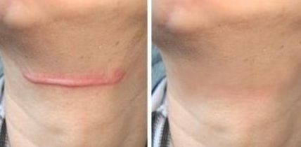 廣州哪家醫(yī)院植皮術(shù)效果好、專業(yè)的醫(yī)院推薦