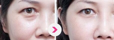 北京哪位醫(yī)生擅長巨乳縮小手術(shù)？5名實力醫(yī)生值得推薦