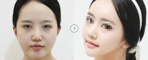 溫州哪家醫(yī)院祛除疤痕效果最佳，專家推薦！