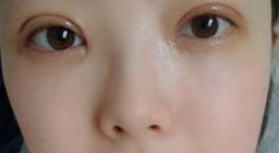 上海哪家醫(yī)院的雙眼皮手術(shù)效果最好？