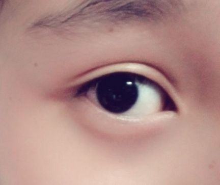 上饒祛眼袋哪家醫(yī)院好？解析上饒地區(qū)的眼袋整形醫(yī)院排名及選擇標(biāo)準(zhǔn)