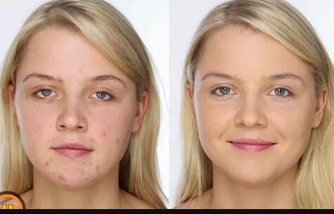 李曉東胸部整形效果怎么樣？實地調(diào)研分享