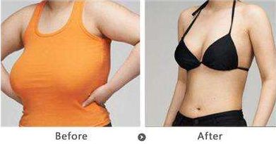 深圳雙眼皮修復哪家好？機構(gòu)排名及評價調(diào)查報告