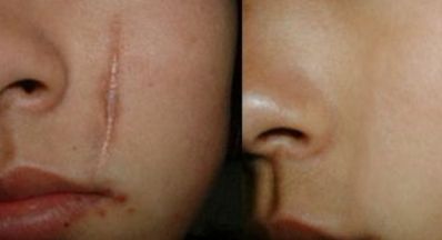 蘭州眼部修復(fù)手術(shù)哪家好？眼部整形專家為您推薦最佳選擇！