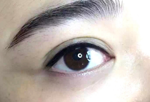 李東磨骨在北京三院，了解一下手術(shù)費(fèi)用如何