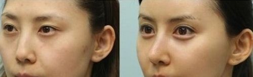 探尋上海玻尿酸隆鼻哪家好？選擇最優(yōu)質(zhì)的上海玻尿酸隆鼻機(jī)構(gòu)