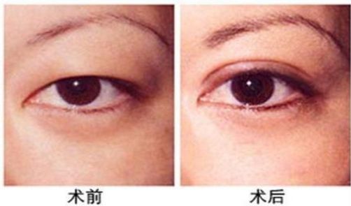 杭州做激光眼科手術(shù)哪家醫(yī)院好，專家推薦