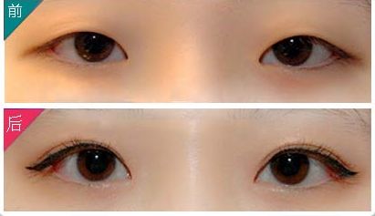 廣州哪家醫(yī)院祛眼袋效果好，專業(yè)的眼袋整形醫(yī)院推薦