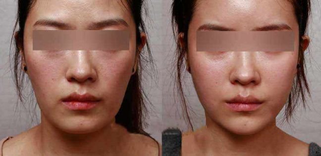 青島水光針推薦醫(yī)院排行榜：哪家醫(yī)院好？