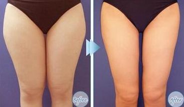 上海光澤醫(yī)院熱瑪吉效果如何？價格是多少？搭配醫(yī)生介紹一起了解