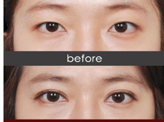 衡陽(yáng)哪家醫(yī)院瘦臉針效果好且價(jià)格合理？