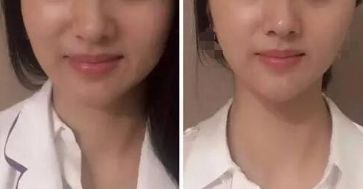 杭州激光祛斑好嗎？哪家激光祛斑的效果好？