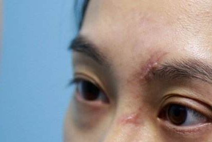 成都哪家醫(yī)院的脂肪填充臉效果好且安全？