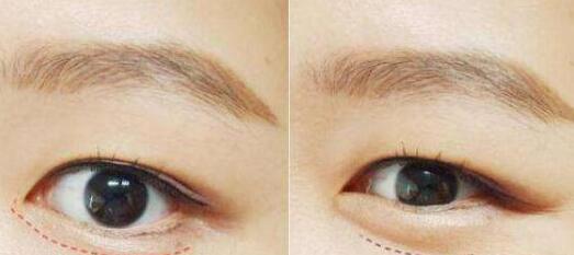 增美天使沈正宇教你打造完美鼻梁！深度揭秘示范案例，秀出新顏！