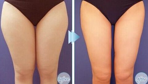 深圳米蘭柏羽雙眼皮效果好嗎？朱武根醫(yī)生值得推薦嗎？院內(nèi)眼部整形特色有哪些？