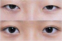 2023青島無痕微雕開眼角醫(yī)生綜合實力排行榜(管玉龍、魏邦敏、季明光個個實力強橫)