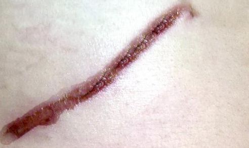 鐳射溶脂杭州哪家醫(yī)院好？專家推薦排名前三的權威醫(yī)院