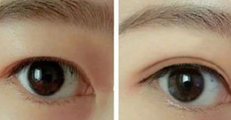 杭州同榮麗格郭同榮抽脂效果如何？醫(yī)生評價(jià)怎樣？