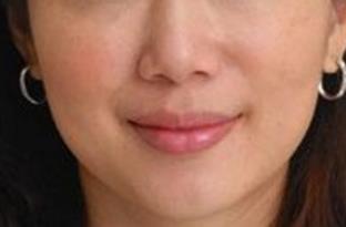 2023蘇州下面部拉皮手術(shù)切口在榜名單top10專家(張娟、李艷、樸光哲口碑遠(yuǎn)超同行)