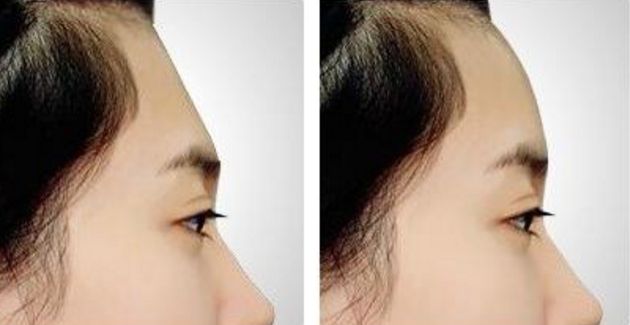 南京割雙眼皮哪家醫(yī)院效果好？