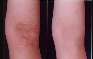 廈門哪家醫(yī)院整鼻子效果好，選擇哪家醫(yī)院才能安心？