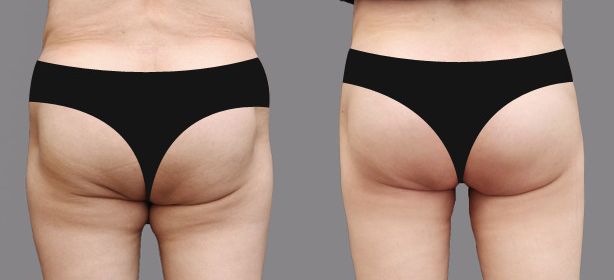 上海吸脂豐胸醫(yī)院哪家好？選擇最值得信賴的上海豐胸整形醫(yī)院