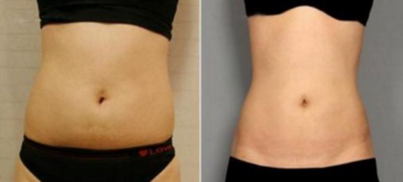 武漢玻尿酸填充效果怎么樣？哪家醫(yī)院值得選擇？