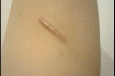 濟寧哪家做假體隆胸好？揭秘濟寧最受歡迎的假體隆胸醫(yī)院！