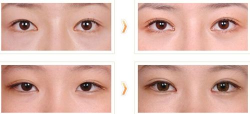 2023煙臺(tái)外眼角懸吊術(shù)前十專家排行(李岳令、張洪達(dá)、張鵬前十詳細(xì)點(diǎn)評(píng))