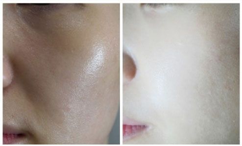 秦皇島祛斑哪家醫(yī)院好？推薦秦皇島哪家醫(yī)院祛斑效果好