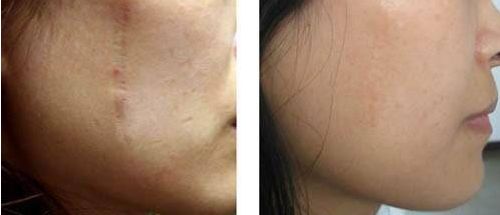 廣州抽脂手術(shù)哪家醫(yī)院最靠譜？