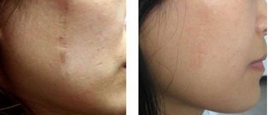 長春激光祛痘，哪家好？排名靠前的專業(yè)美容機構有哪些？