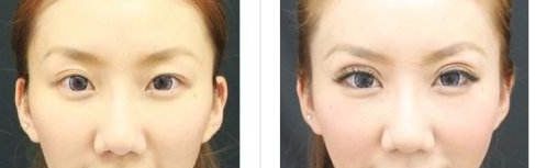 株洲哪家醫(yī)院做雙眼皮好？選擇醫(yī)院要注意這幾個(gè)關(guān)鍵點(diǎn)！