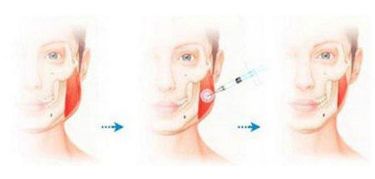 南京假體隆鼻哪家醫(yī)院效果最好？